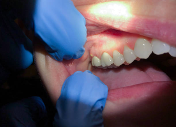 Best Emergency Gum Treatment in Ahuimanu, HI