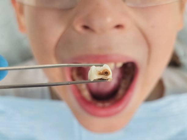 Best Emergency Tooth Extraction in Ahuimanu, HI